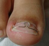 Wrastające paznokcie. Co z nimi zrobić?